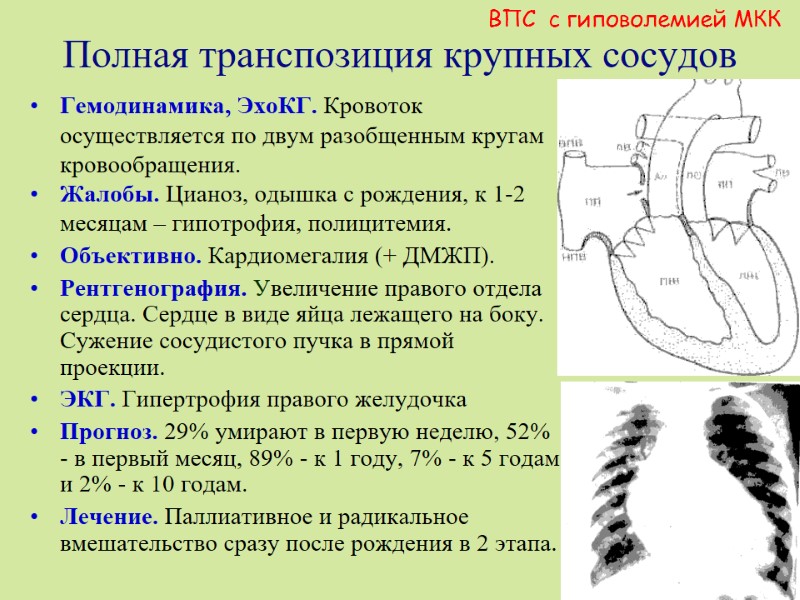 Полная транспозиция крупных сосудов  Гемодинамика, ЭхоКГ. Кровоток осуществляется по двум разобщенным кругам кровообращения.